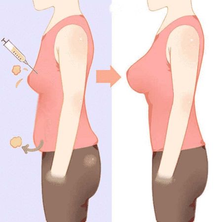 Breast Augmentation – Fat Transfer in Toronto