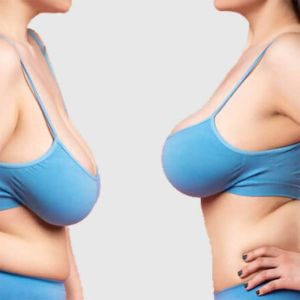 Breast Reduction Surgery in Ludhiana