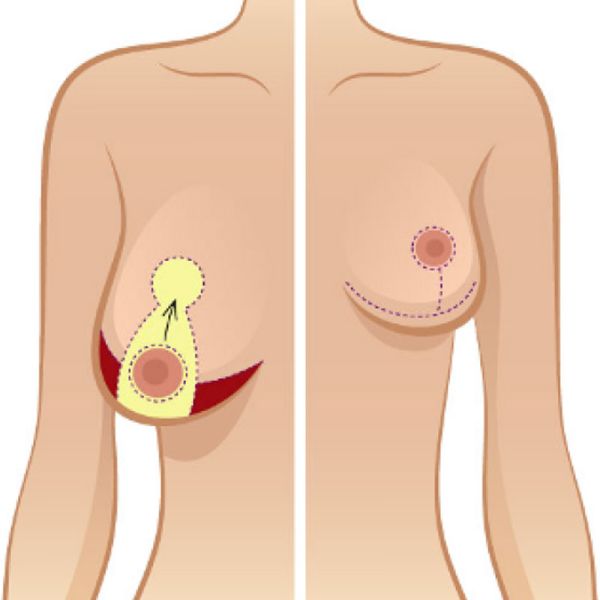 Best Breast Reduction Surgeon in Ludhiana