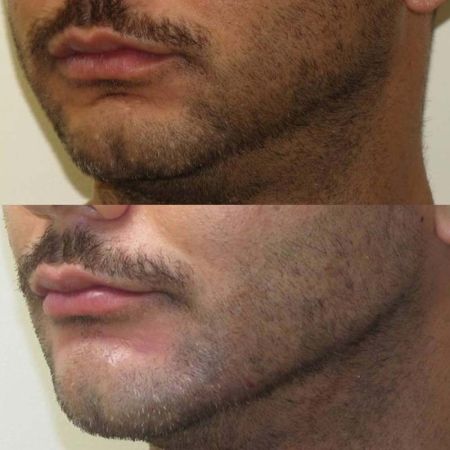 Chin Augmentation Surgery in Calgary