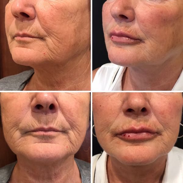 FaceTite Treatment in Toronto