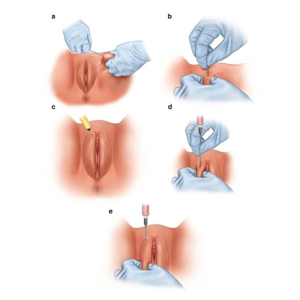 Fat Transfer To Vulva in Toronto