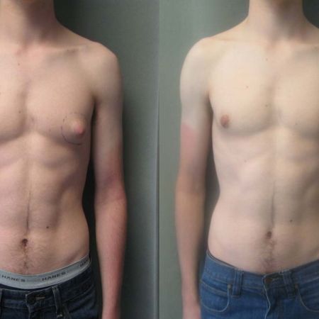 Gynaecomastia Surgery / Male Breast Reduction in Toronto