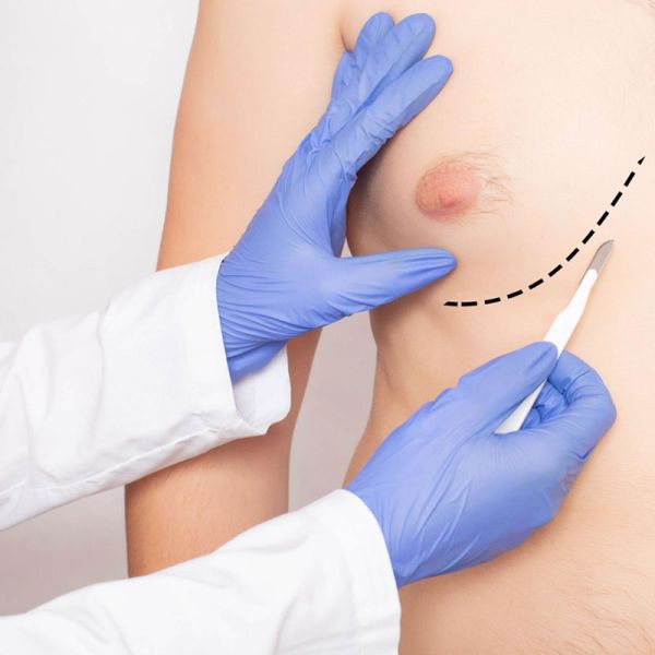 Best Male Breast Reduction Surgeon in Ludhiana