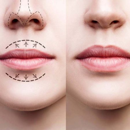 Lip Reduction Surgery in Calgary