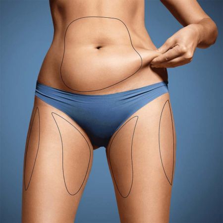 Liposuction in Toronto