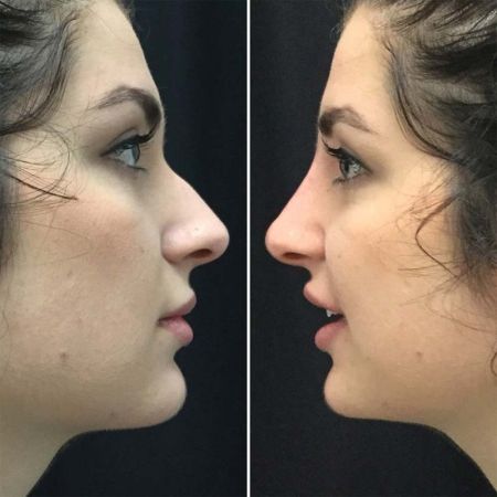 Rhinoplasty / Nose Surgery in Toronto