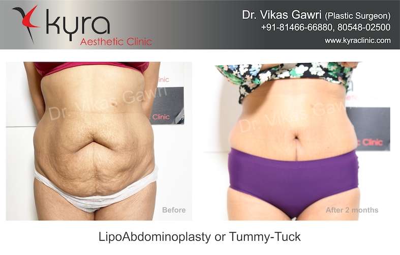 Tummy Tuck Surgery in Kurukshetra, Abdominoplasty in Kurukshetra