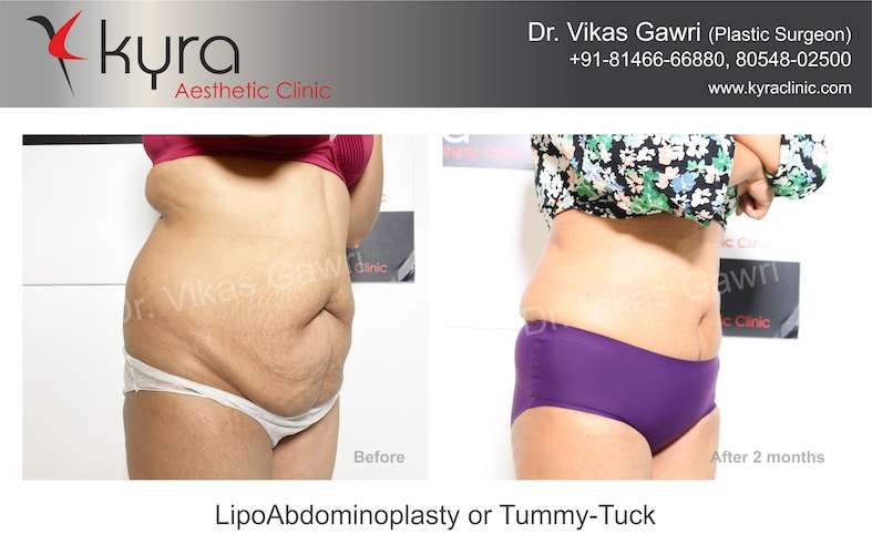 Tummy Tuck Surgery in Ludhiana, Abdominoplasty in Ludhiana, India
