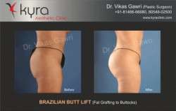 Brazilian Butt Lift Surgery In Delhi & Gurgaon - BBL Surgery Cost